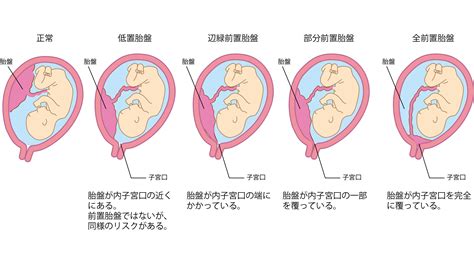 低位胎盤|胎盤の位置異常（前置胎盤・低置胎盤）の管理